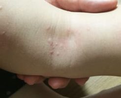 アトピーや皮膚炎系が治ることはない