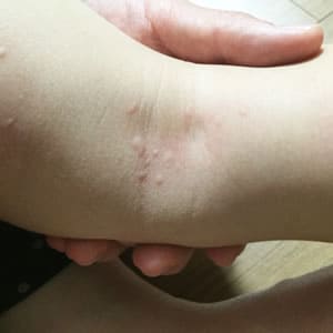 アトピーや皮膚炎系が治ることはない